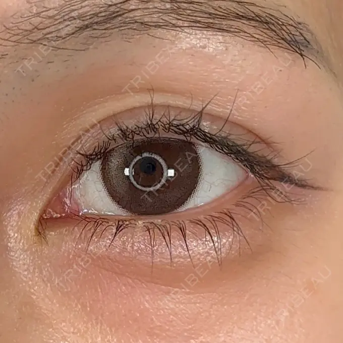 二重埋没 アリエル美容クリニック 横浜院 DAY 39 メイン用