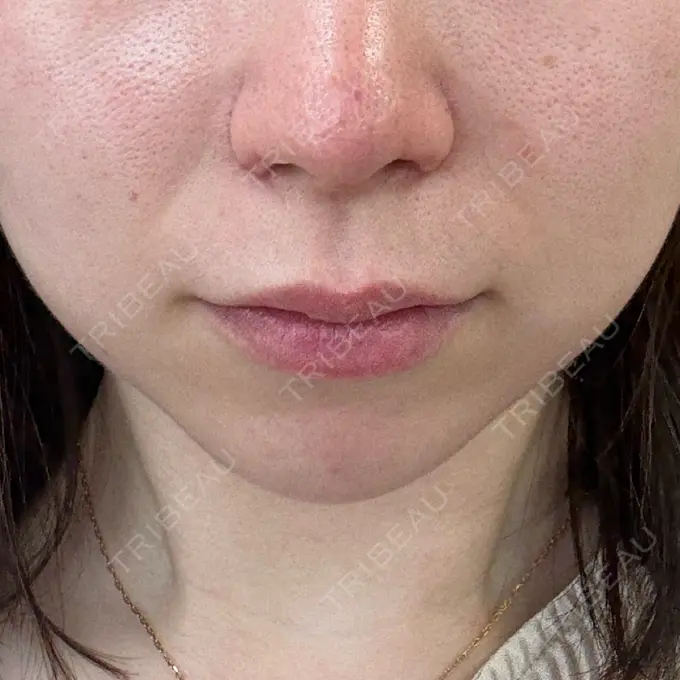 鼻尖形成（切開） / 小鼻縮小（切開） / 軟骨移植 / 鼻尖縮小 ASTRA BEAUTY CLINIC DAY 21 メイン用