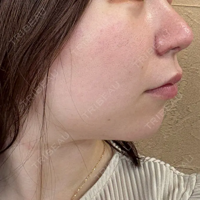 鼻尖形成（切開） / 小鼻縮小（切開） / 軟骨移植 / 鼻尖縮小 ASTRA BEAUTY CLINIC DAY 21 メイン用