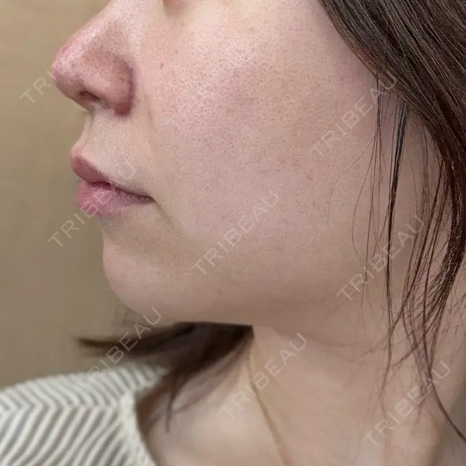 鼻尖形成（切開） / 小鼻縮小（切開） / 軟骨移植 / 鼻尖縮小 ASTRA BEAUTY CLINIC DAY 21 メイン用