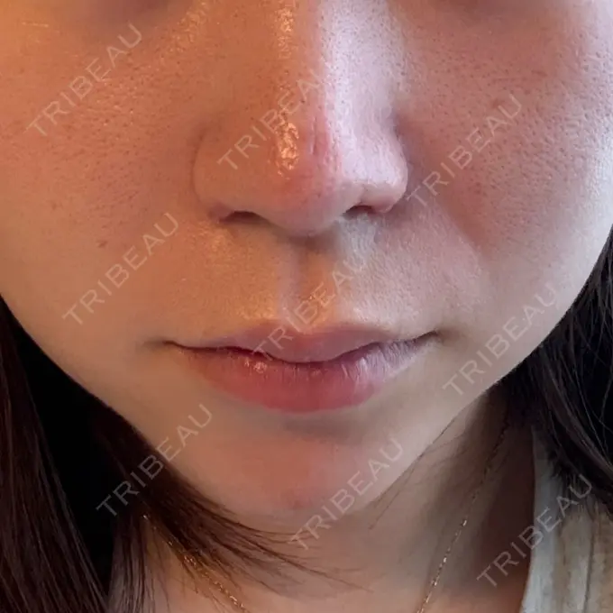 鼻尖形成（切開） / 小鼻縮小（切開） / 軟骨移植 / 鼻尖縮小 ASTRA BEAUTY CLINIC DAY 29 メイン用