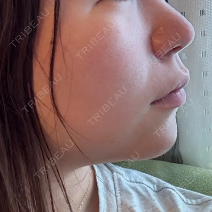 鼻尖形成（切開） / 小鼻縮小（切開） / 軟骨移植 / 鼻尖縮小 ASTRA BEAUTY CLINIC DAY 29 メイン用