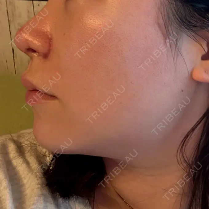 鼻尖形成（切開） / 小鼻縮小（切開） / 軟骨移植 / 鼻尖縮小 ASTRA BEAUTY CLINIC DAY 29 メイン用