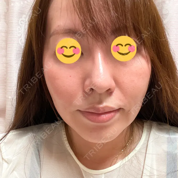 水光注射（ハリ・美肌） / ボトックス（口角） / シワ取りボトックス / マイクロボトックス / 多汗症治療（ボトックス） 筋肉・美容クリニック AFTER メイン用