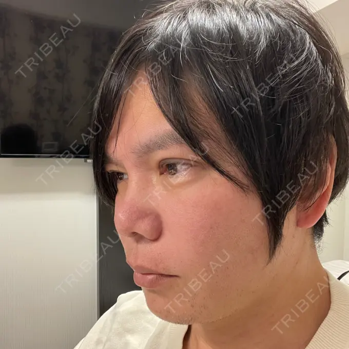 斜鼻修正 / 切開リフト / 眼瞼下垂（非切開） id（アイディ）美容外科 AFTER メイン用