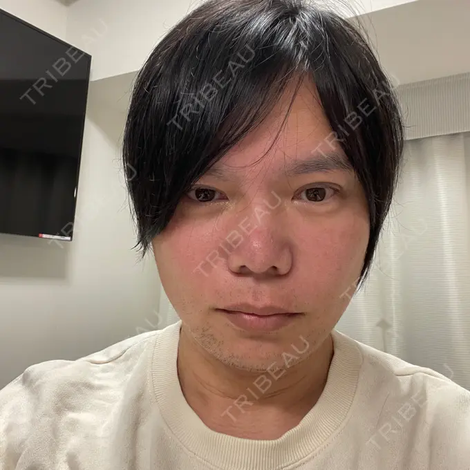 斜鼻修正 / 切開リフト / 眼瞼下垂（非切開） id（アイディ）美容外科 DAY 46 メイン用