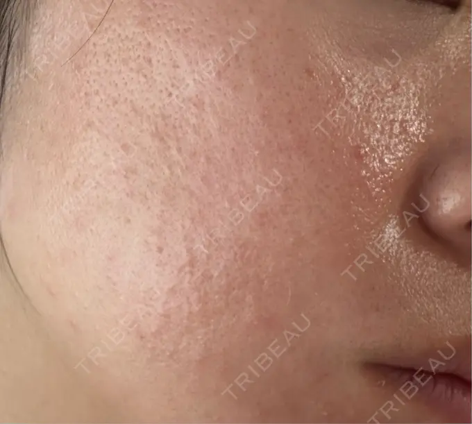 ピコレーザートーニング（美白・肝斑） / ピコフラクショナルレーザー（毛穴・ニキビ跡） おおかみ美容のクリニック 横浜院 DAY 3 メイン用