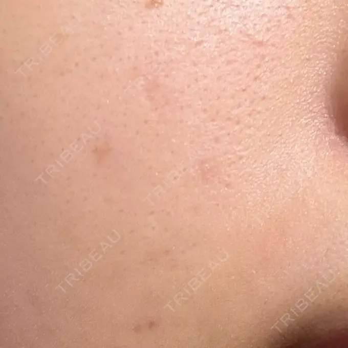 ほくろ・いぼ除去レーザー（肌） みやた形成外科・皮ふクリニック AFTER メイン用