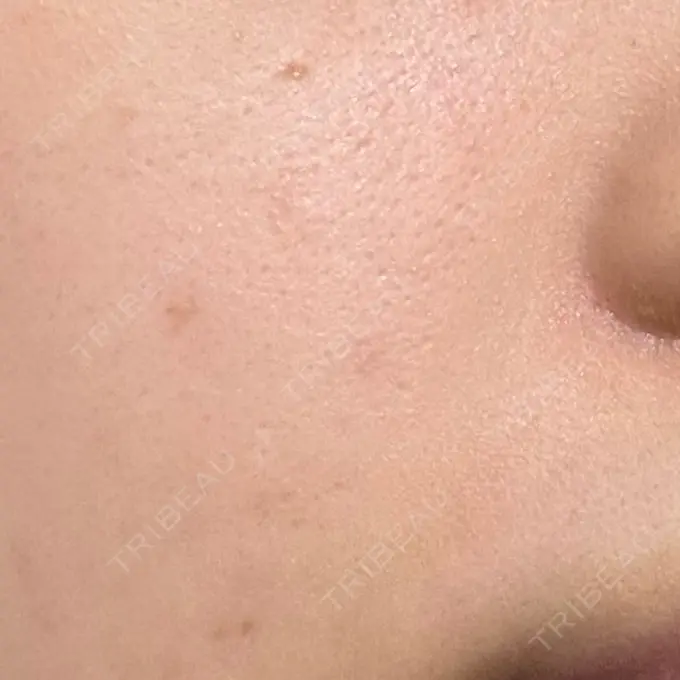 ほくろ・いぼ除去レーザー（肌） みやた形成外科・皮ふクリニック DAY 180 メイン用