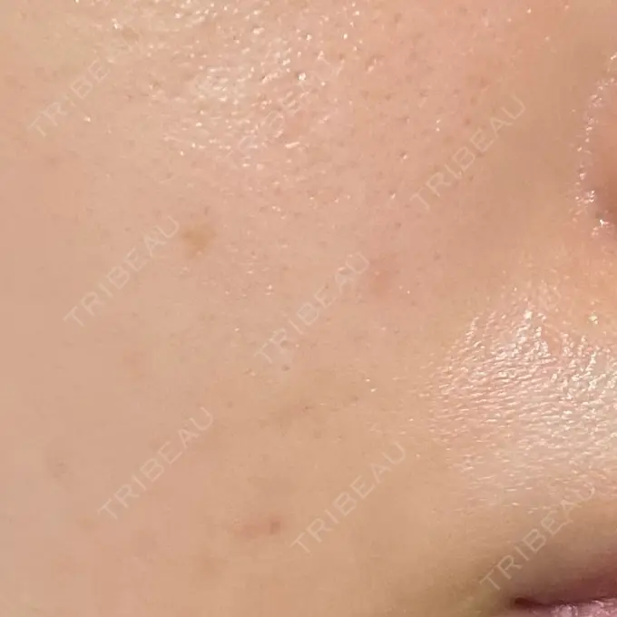 ほくろ・いぼ除去レーザー（肌） みやた形成外科・皮ふクリニック DAY 181 メイン用