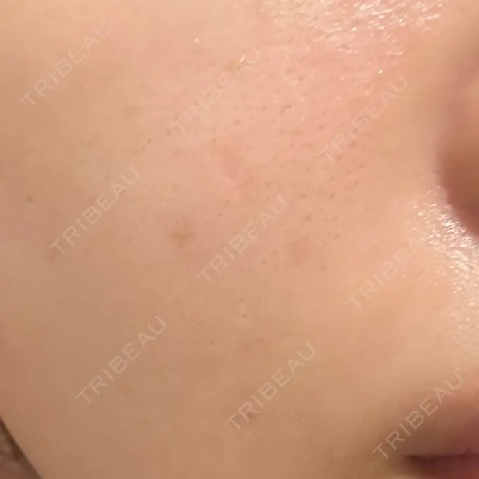 ほくろ・いぼ除去レーザー（肌） みやた形成外科・皮ふクリニック DAY 174 メイン用