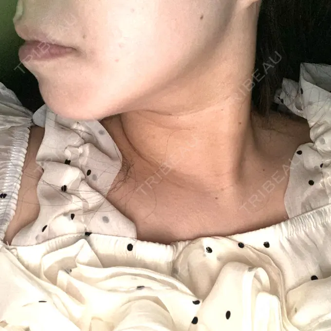 その他（輪郭） ルラ美容クリニック 渋谷本院 DAY 34 メイン用