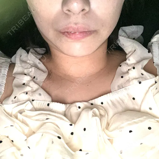 その他（輪郭） ルラ美容クリニック 渋谷本院 DAY 34 メイン用