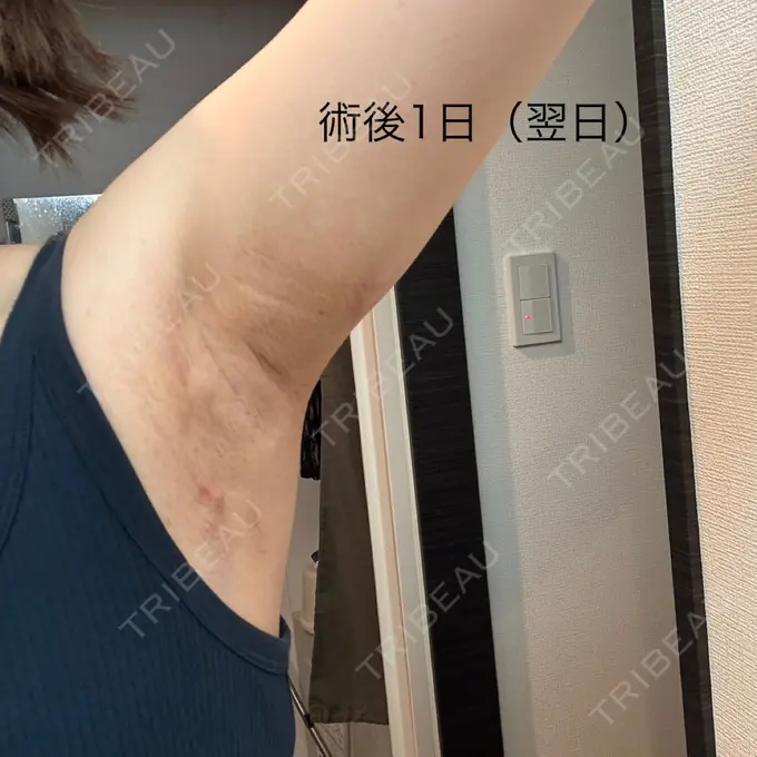 ワキ汗治療（ボトックス） / ワキ汗治療（レーザー） ルラ美容クリニック 渋谷本院 DAY 0 メイン用