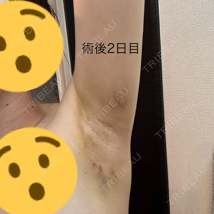 ワキ汗治療（ボトックス） / ワキ汗治療（レーザー） ルラ美容クリニック 渋谷本院 DAY 0 メイン用