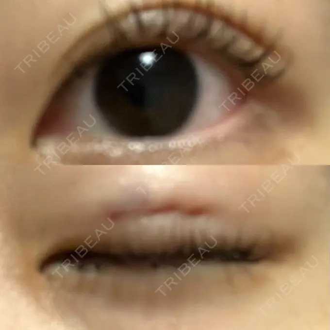 二重埋没 水の森美容クリニック 名古屋院 DAY 0 メイン用