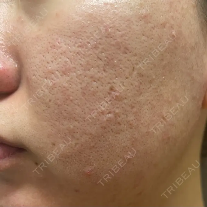 マイクロボトックス SUNMELIA SKIN CLINIC DAY 0 メイン用