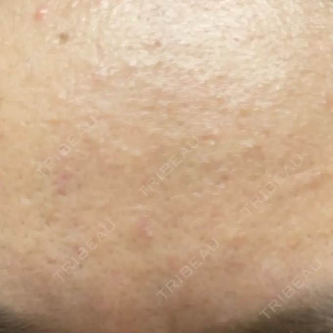 マイクロボトックス SUNMELIA SKIN CLINIC DAY 0 メイン用