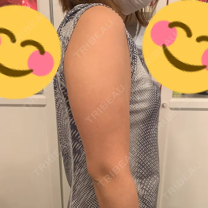 脂肪溶解注射（二の腕） / その他（ボディ） チョンダムジュエンクリニック DAY 4 メイン用