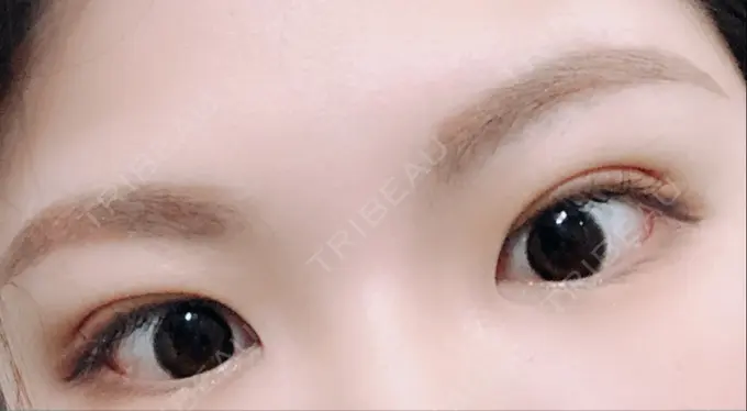 二重埋没 城本クリニック 福岡院 DAY 19 メイン用