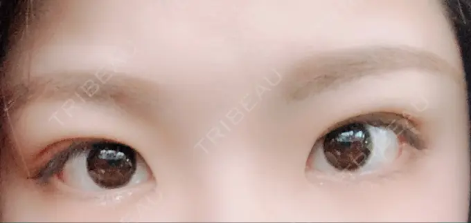 二重埋没 城本クリニック 福岡院 DAY 20 メイン用