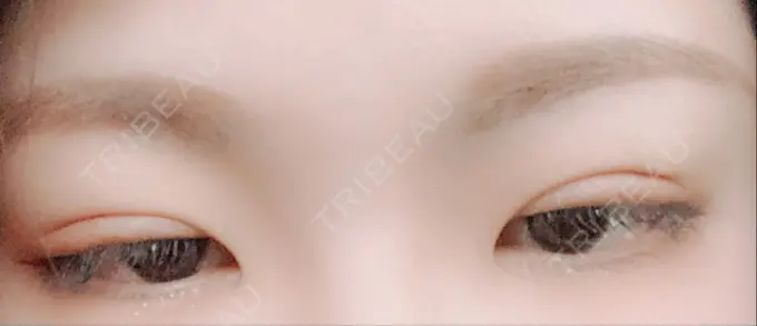 二重埋没 城本クリニック 福岡院 DAY 20 メイン用