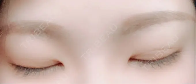 二重埋没 城本クリニック 福岡院 DAY 20 メイン用