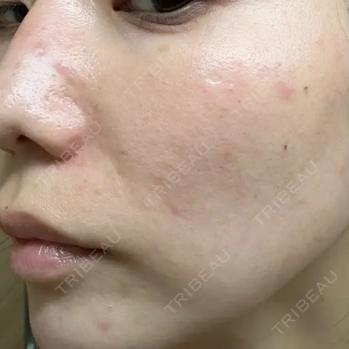 イオン導入 / 美肌レーザー / 美白レーザー / レーザートーニング（美白・肝斑） MAクリニック 心斎橋 DAY 0 メイン用