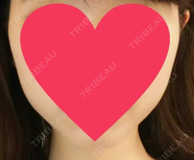 ハイフ（顔） 赤坂プレミアクリニック DAY 5 メイン用