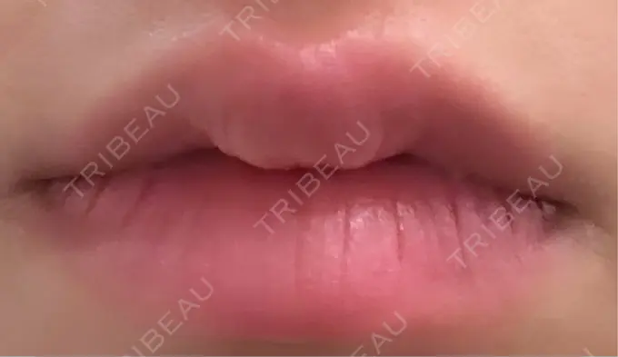 ヒアルロン酸注入（唇） MKクリニック 日本橋院 AFTER メイン用