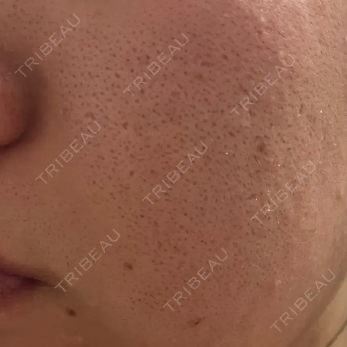 マイクロボトックス SUNMELIA SKIN CLINIC DAY 1 メイン用