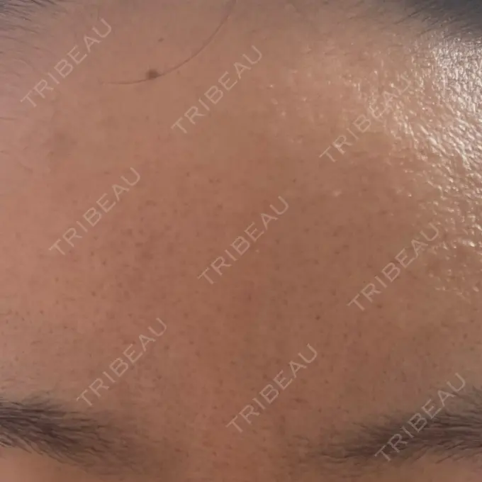 マイクロボトックス SUNMELIA SKIN CLINIC DAY 1 メイン用