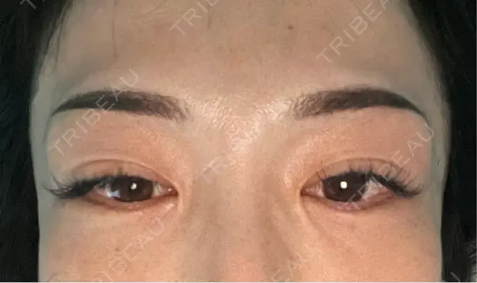 アートメイク（眉） 湘南AGAクリニック 大阪院 DAY 5 メイン用