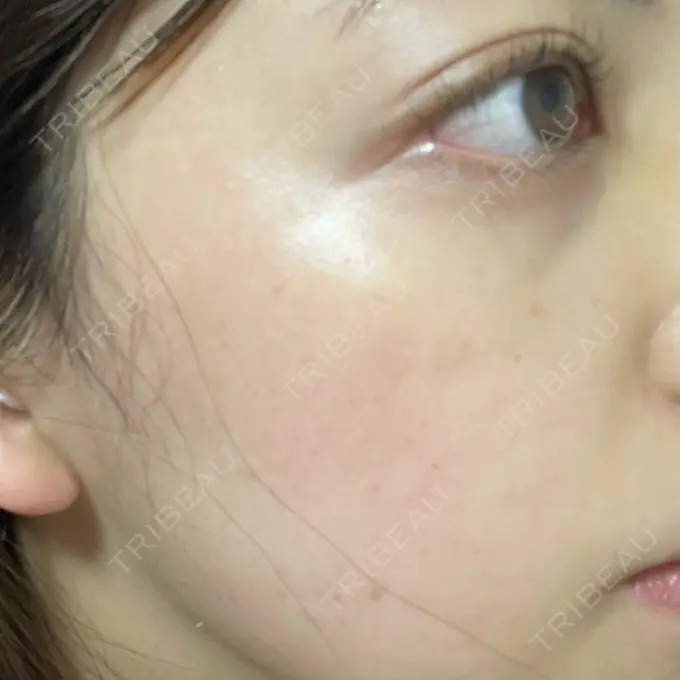 エレクトロポレーション / ルメッカ ウィルビークリニック 新宿院 AFTER メイン用