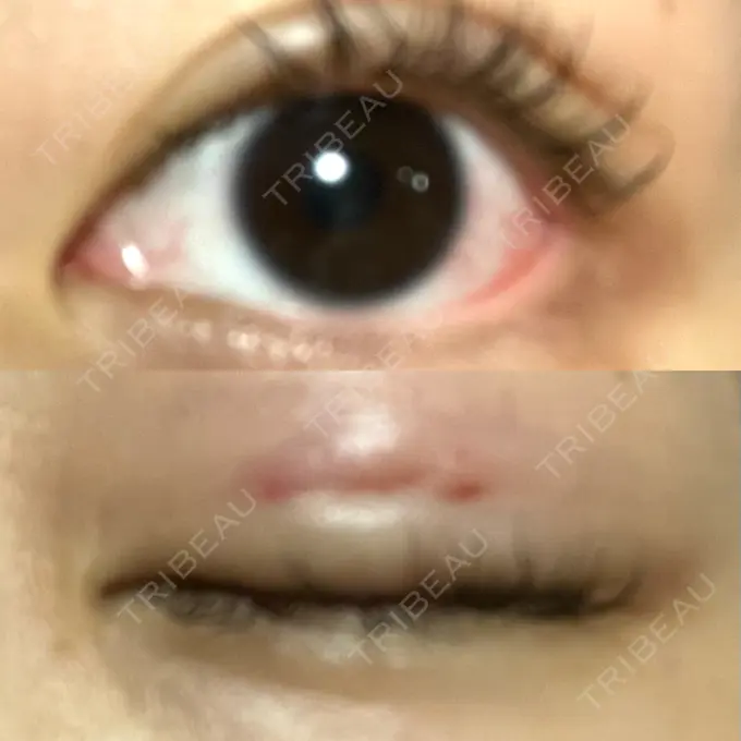 二重埋没 水の森美容クリニック 名古屋院 DAY 1 メイン用