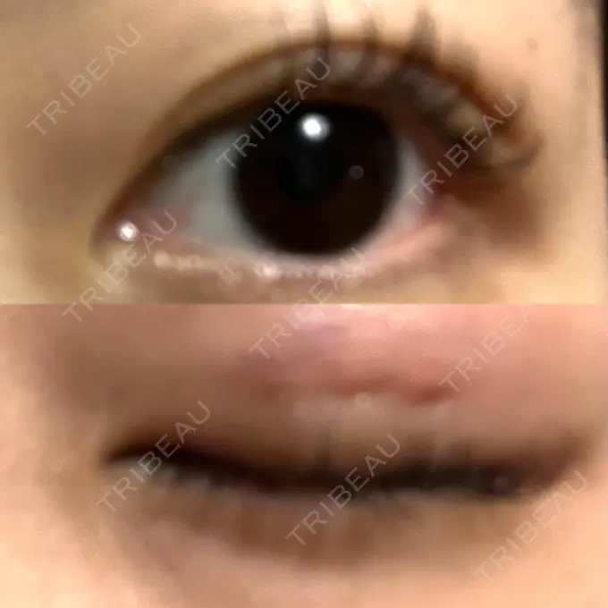 二重埋没 水の森美容クリニック 名古屋院 DAY 2 メイン用