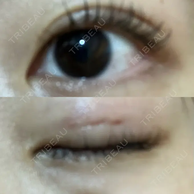 二重埋没 水の森美容クリニック 名古屋院 DAY 3 メイン用