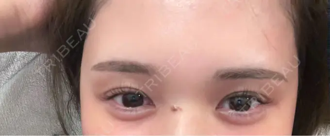 ヒアルロン酸注入（涙袋） / ワキ汗治療（ボトックス） / ボトックス（額） / ボトックス（人中） ルヴィクリニック イオンドーム前院 AFTER メイン用