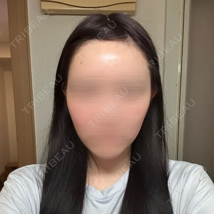 糸リフト 東京シンデレラ美容外科 池袋院 AFTER メイン用