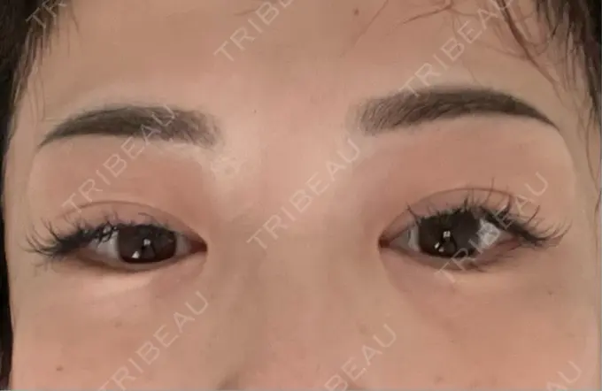 アートメイク（眉） 湘南AGAクリニック 大阪院 DAY 6 メイン用