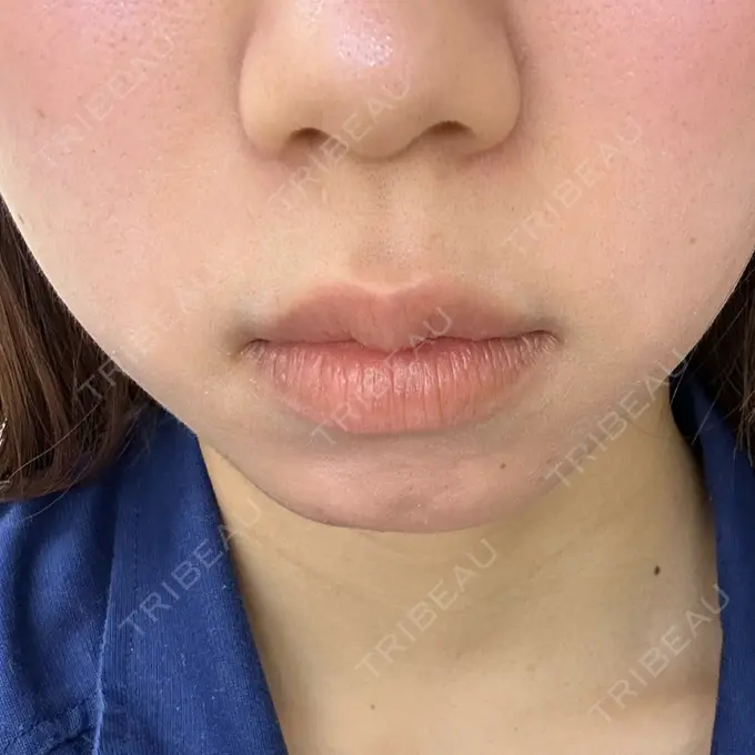 ヒアルロン酸注入（あご） フィラークリニック 名古屋栄院 AFTER メイン用