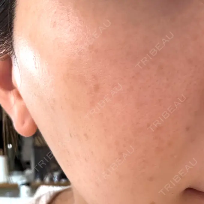 イオン導入 / ピーリング（ハリ・ツヤ） / ルメッカ ルラ美容クリニック 名古屋本院 DAY 7 メイン用