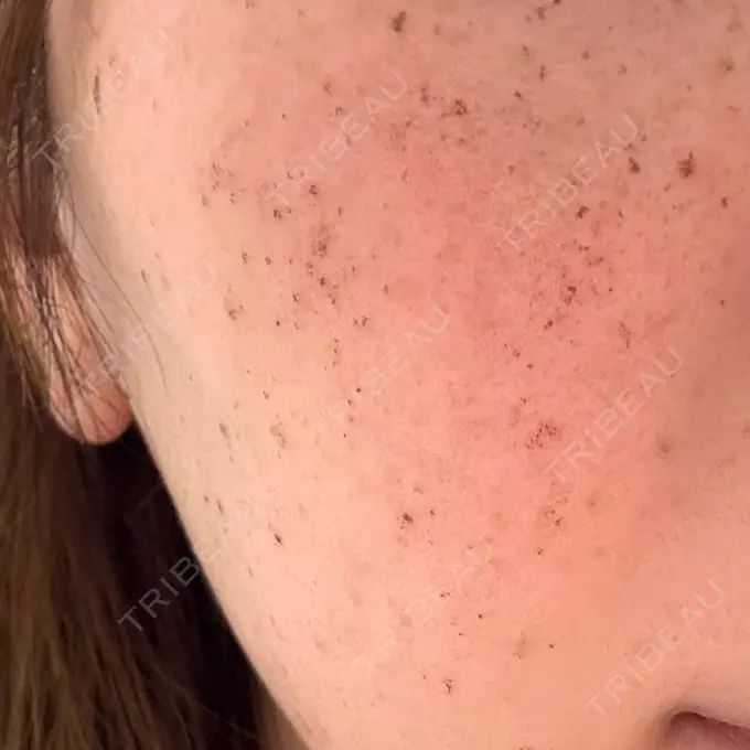 イオン導入 / ピーリング（ハリ・ツヤ） / ルメッカ ルラ美容クリニック 名古屋本院 DAY 7 メイン用