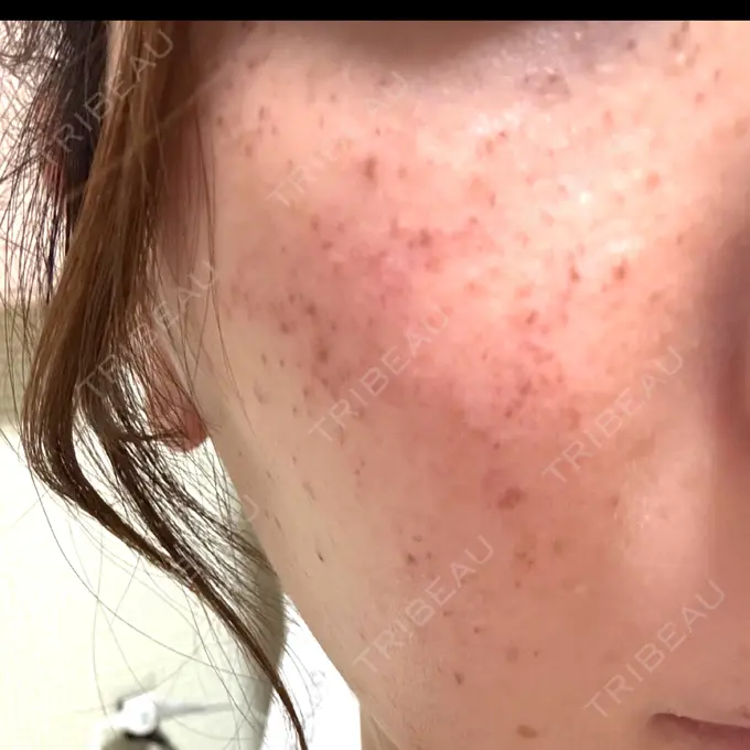 イオン導入 / ピーリング（ハリ・ツヤ） / ルメッカ ルラ美容クリニック 名古屋本院 AFTER メイン用