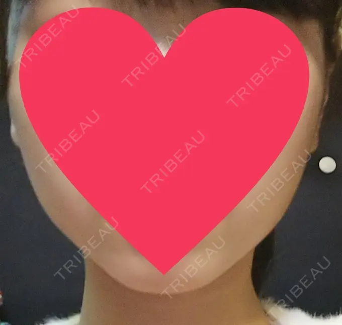 ハイフ（顔） 赤坂プレミアクリニック DAY 13 メイン用