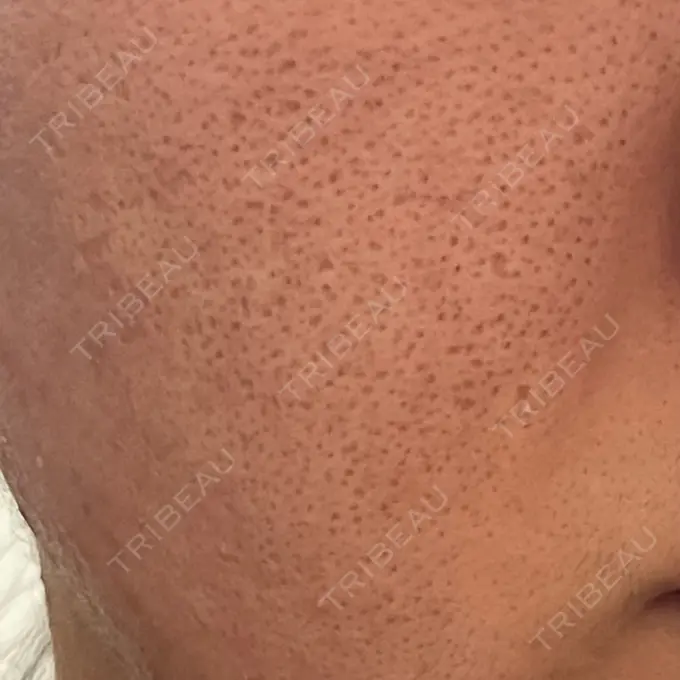 マイクロボトックス SUNMELIA SKIN CLINIC AFTER メイン用