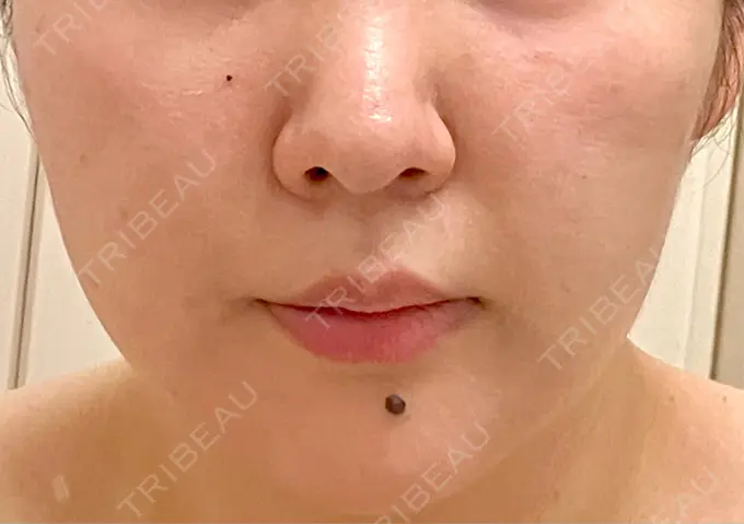 ピーリング（ニキビ・毛穴） / ピコレーザートーニング（美白・肝斑） / フラクショナルレーザー（毛穴・ニキビ跡） / ピコスポット BISIN GINZA CLINIC AFTER メイン用