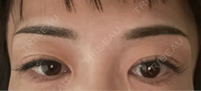 アートメイク（眉） 湘南AGAクリニック 大阪院 DAY 7 メイン用