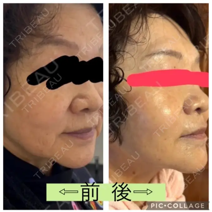 RF（高周波）たるみ治療 共立美容 池袋院 DAY 45 メイン用