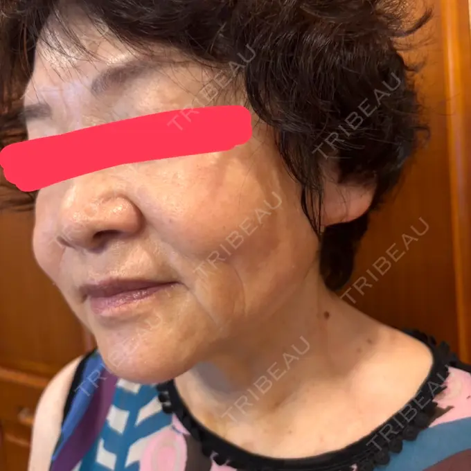 RF（高周波）たるみ治療 共立美容 池袋院 DAY 45 メイン用